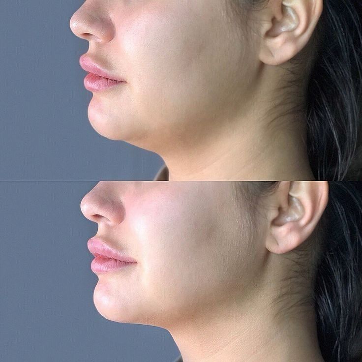 Before and After Pics of Chin Laser Lipo