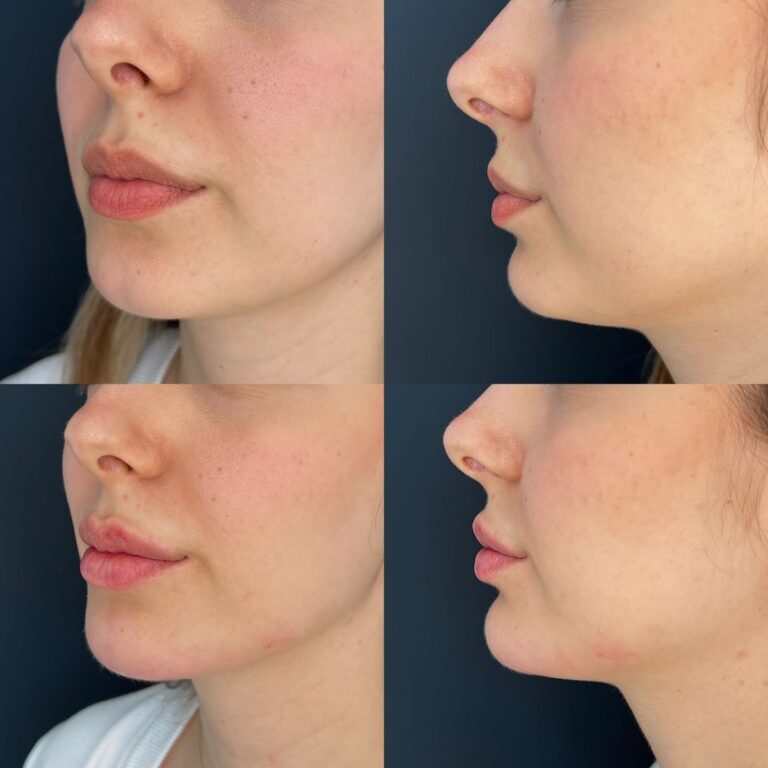 Chin Laser Lipo Before and After