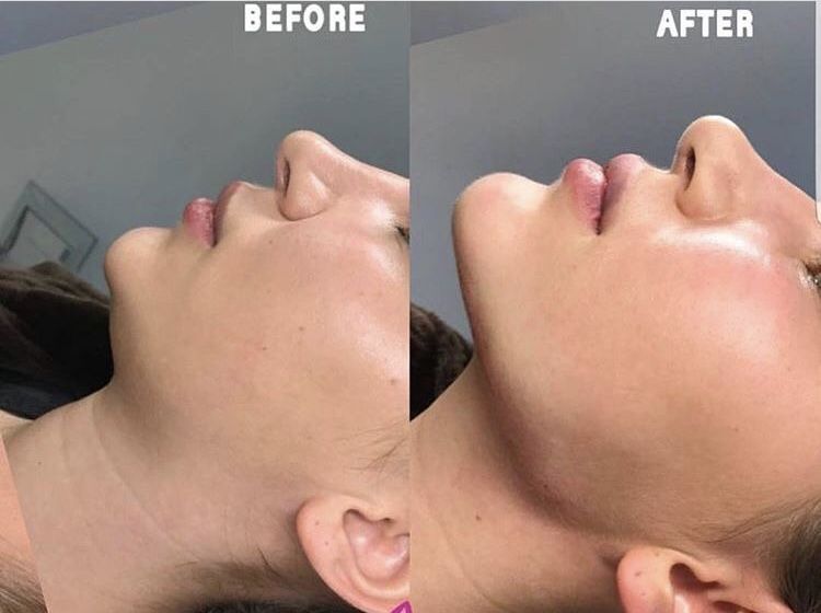Chin Laser Lipo Before and After
