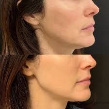 Invasive vs Surgical before and After Result