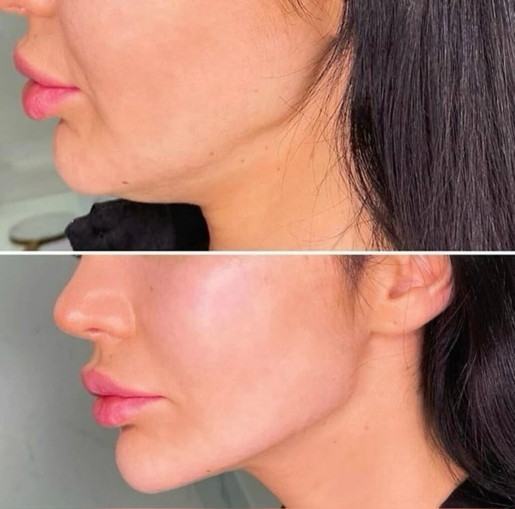Laser Lipo Double Chin Before and After