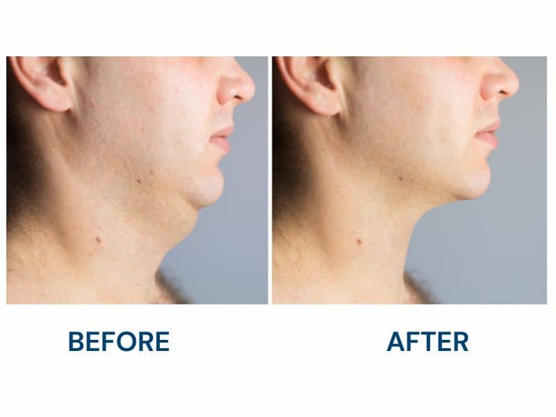 Male Chin Lipo Before and After