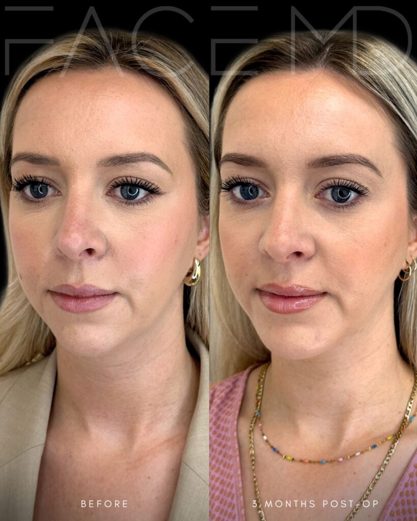 Permanent Chin Lipo Before and After Results