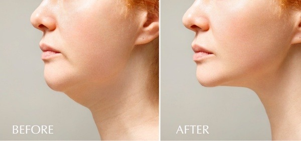 patient-performing-chin-lipo-pinch-test-on-submental-fat