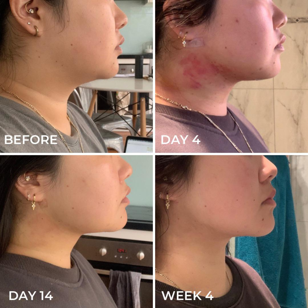 Chin Lipo Recovery Timeline: A Day-by-Day Guide for 2026