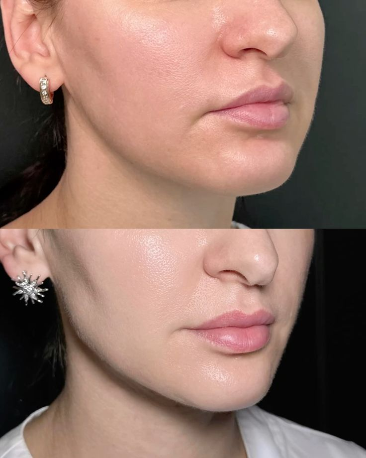 Chin Liposuction Procedure, Techniques, and Technology