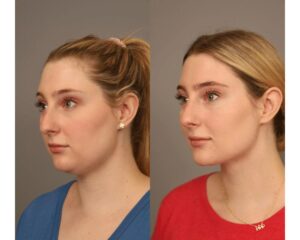 How much does Chin Liposuction cost