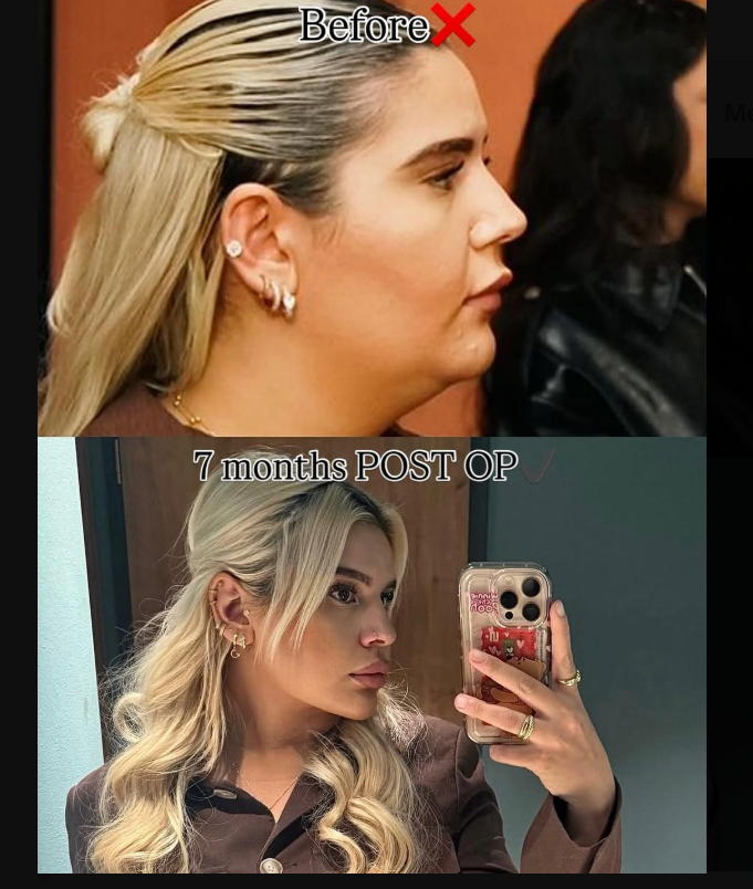 Before and After Chin Lipo